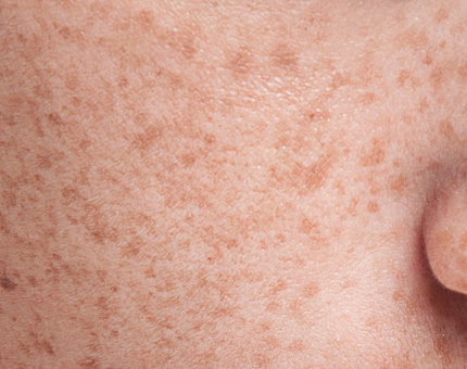 美容院专业线淡斑祛斑特字号产品贴牌代工厂家